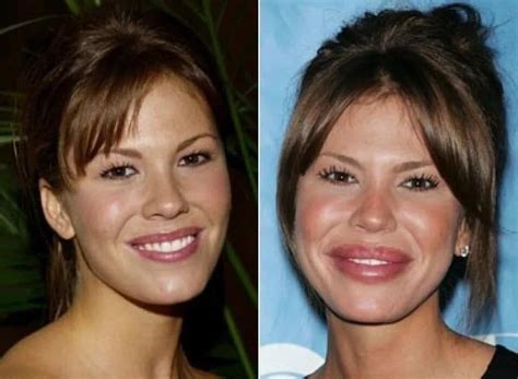 celebrity failed plastic surgery